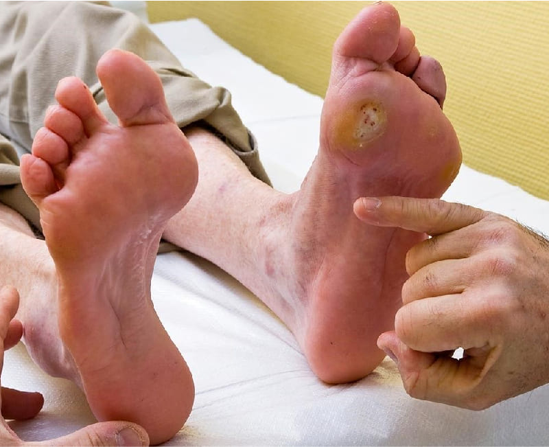 Diabetic Wounds Management