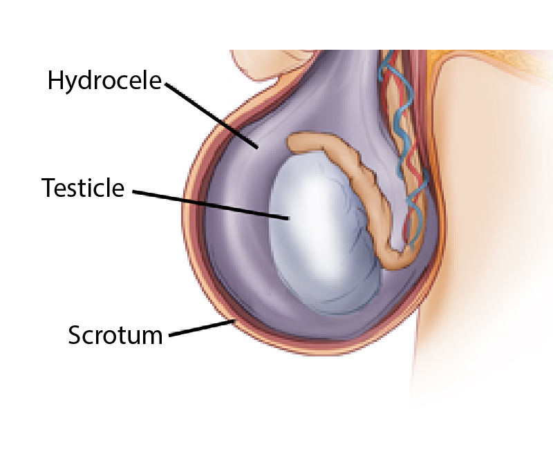 Hydrocele Surgery