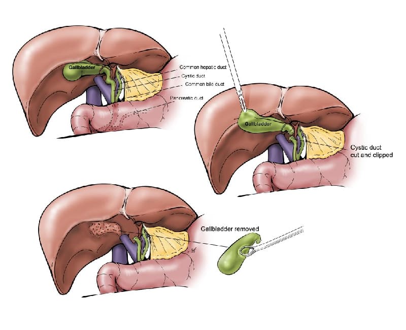 Laparoscopic Gallbladder, Appendix Surgery