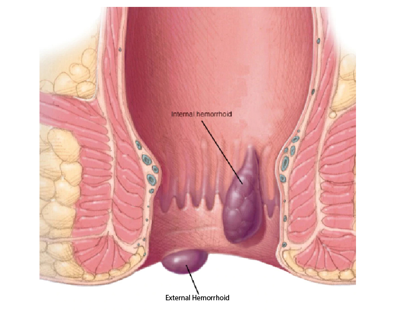 Piles Surgery